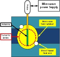 Funktionsweise der Mikrowellenablation